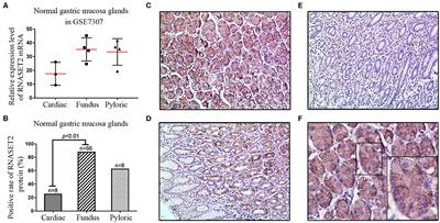 Expression, Location, Clinical Implication, and Bioinformatics Analysis of RNASET2 in Gastric Adenocarcinoma